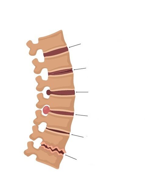 Bone changes in the spine