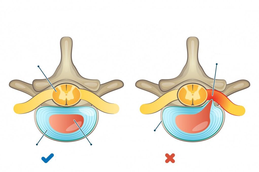 Intervertebral discs - one is healthy, the other is herniated