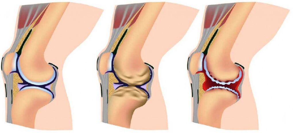 Healthy joints, affected by joints